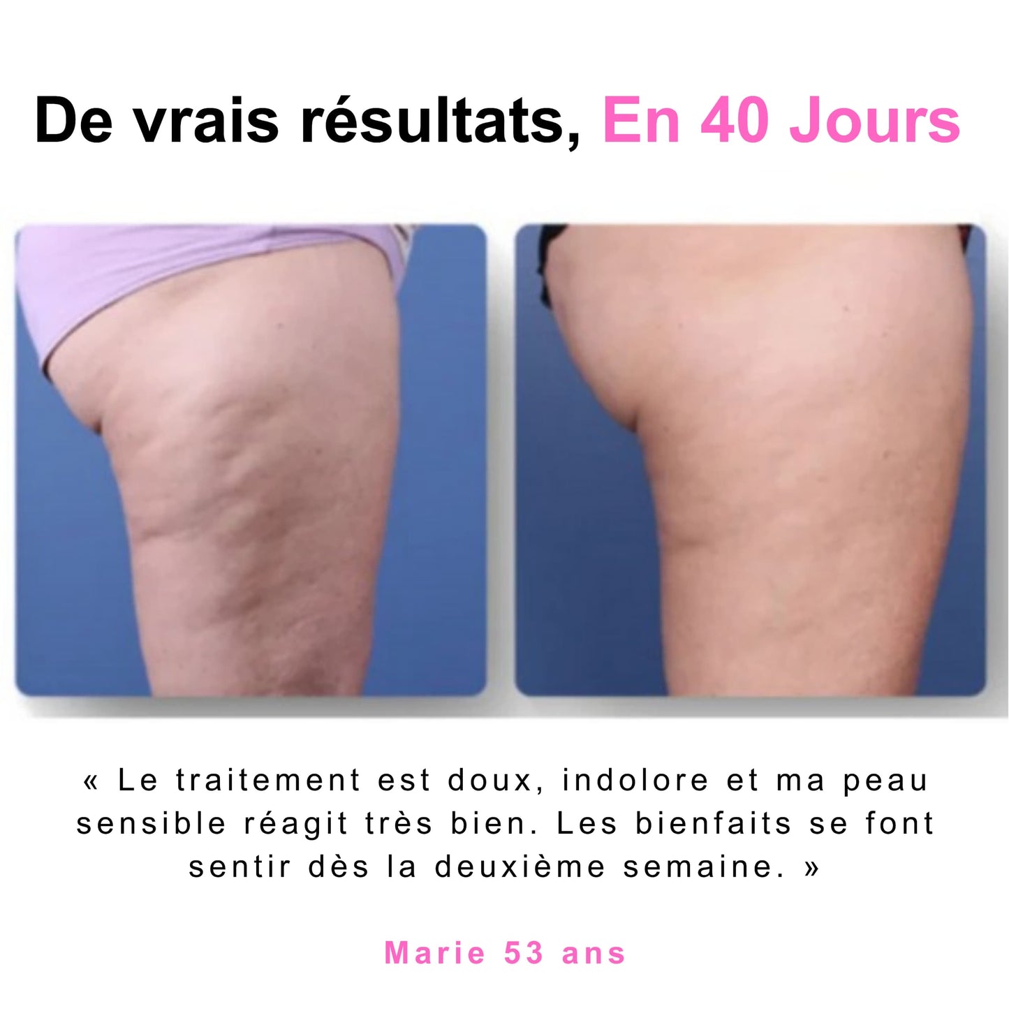 Masseur anti-cellulite Trendora™