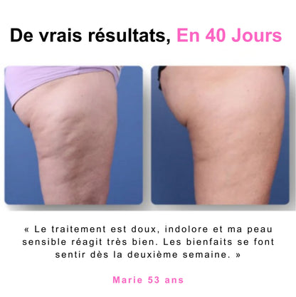 Masseur anti-cellulite Trendora™